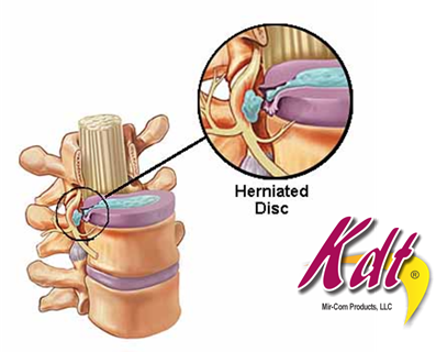 Herniated Disc  Becker Spine and Sports Institute, LLC